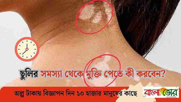 ছুলি দূর করার ক্রিমের নাম