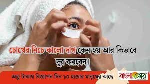 চোখের নিচে কালো দাগ