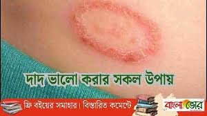 দাদ বা দাউদ ভালো করার ওষুধ ও ঘরোয়া সকল উপায়