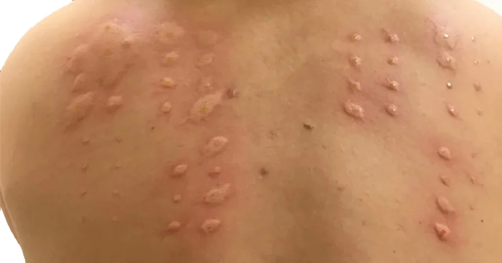 সারা গায়ে চুলকানির কারণ এবং ঔষধ