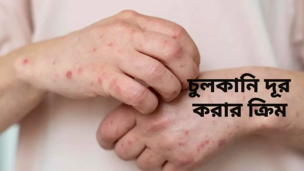 চুলকানি দূর করার ঔষধের নাম