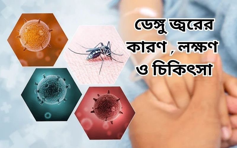 ডেঙ্গু রোগের লক্ষণ ও প্রতিকার
